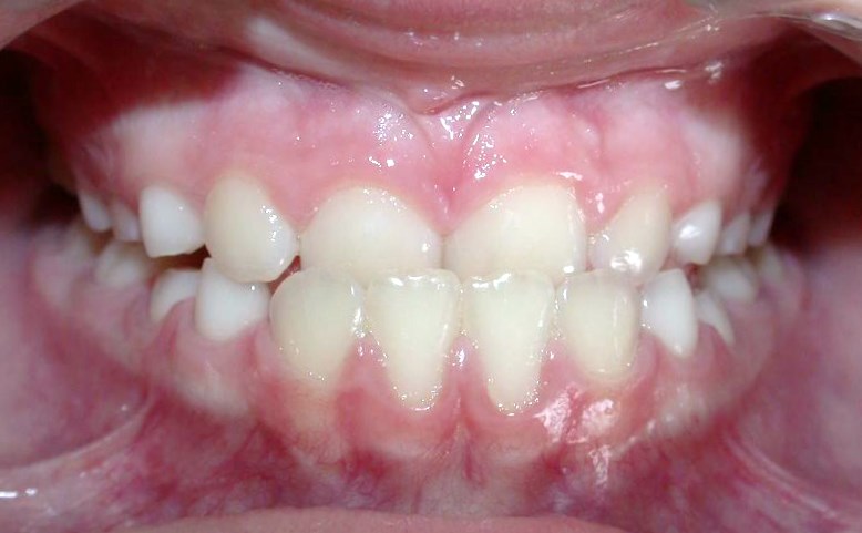 Articulé inversé antéro-posterieur