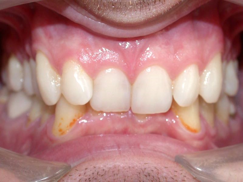 Chevauchement dentaire