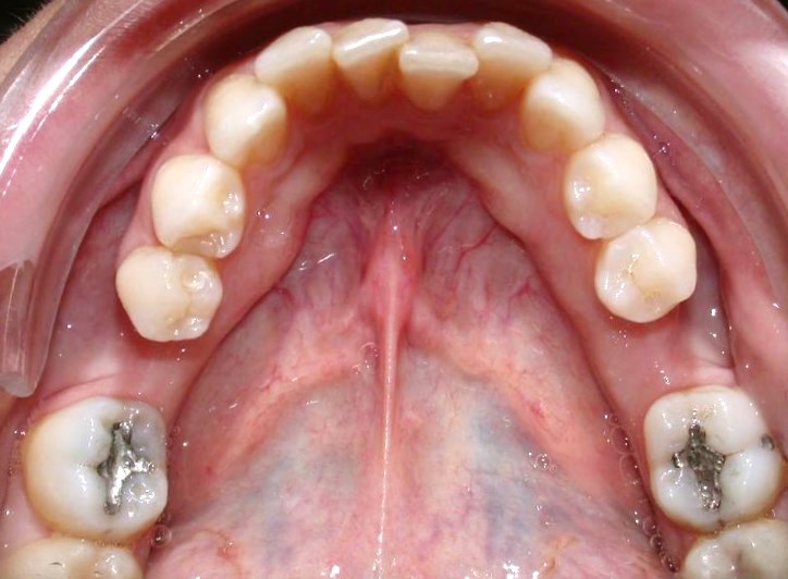 Orthodontie pré-prothétique