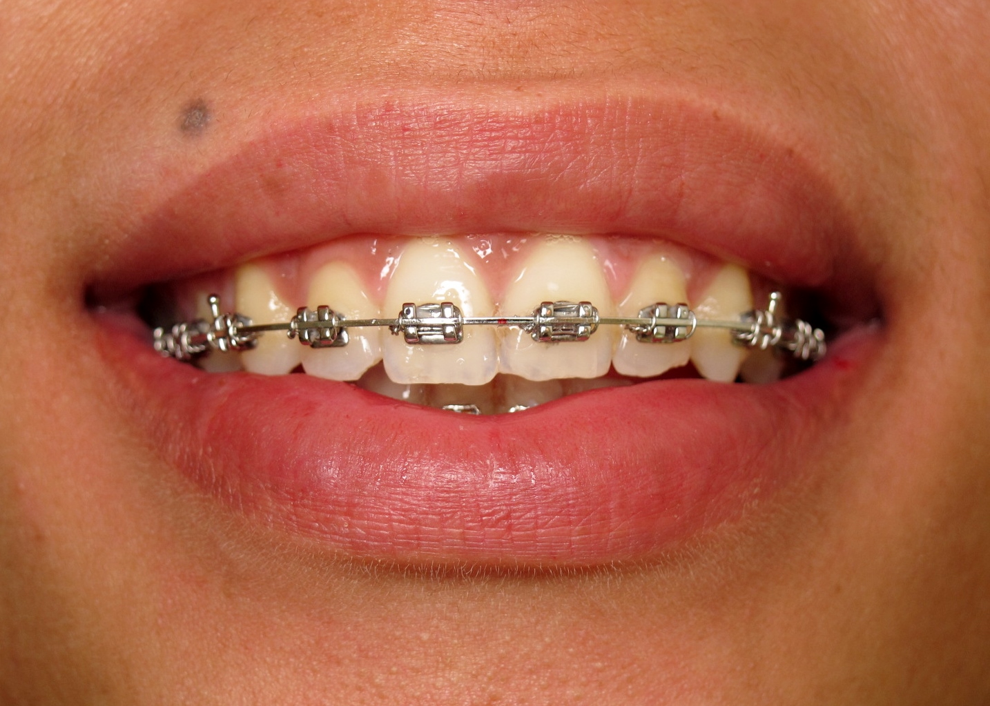 Multibague métallique