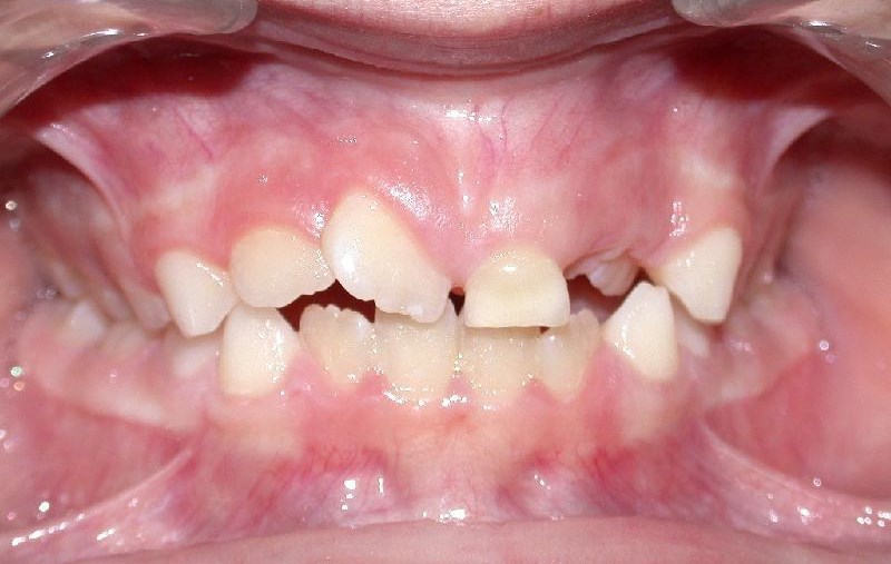 Interposition dentaire