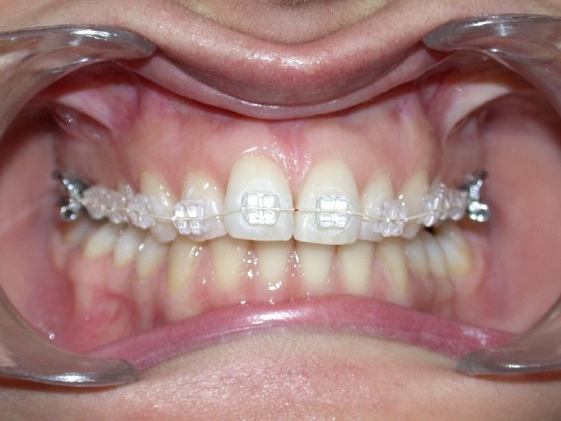 Multibague transparent