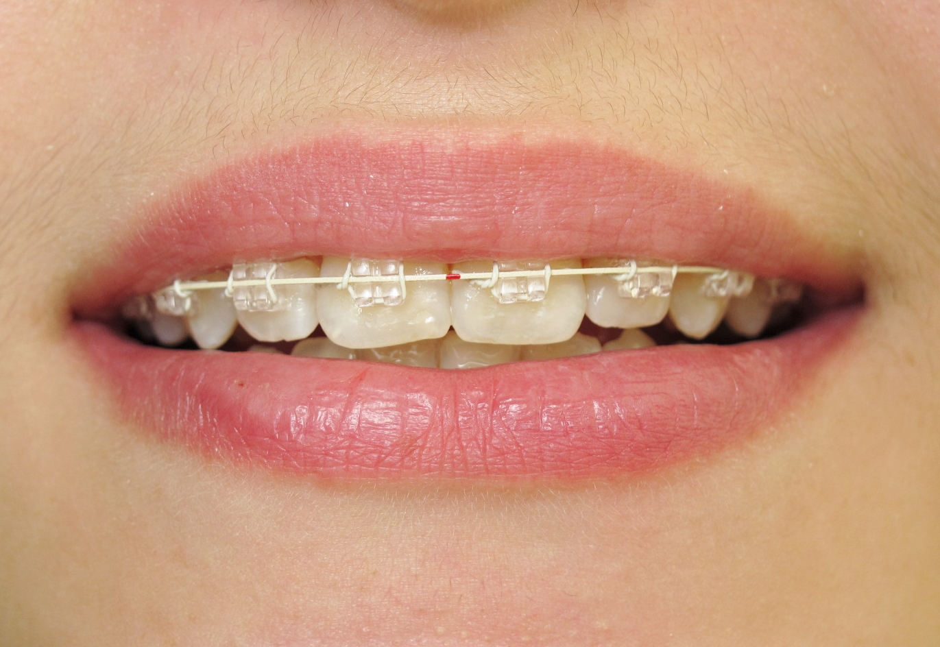 Multibague transparent