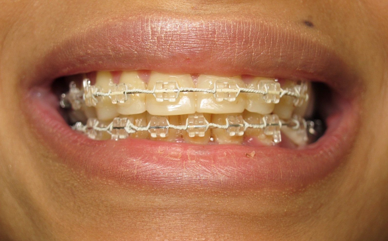 Multibague transparent