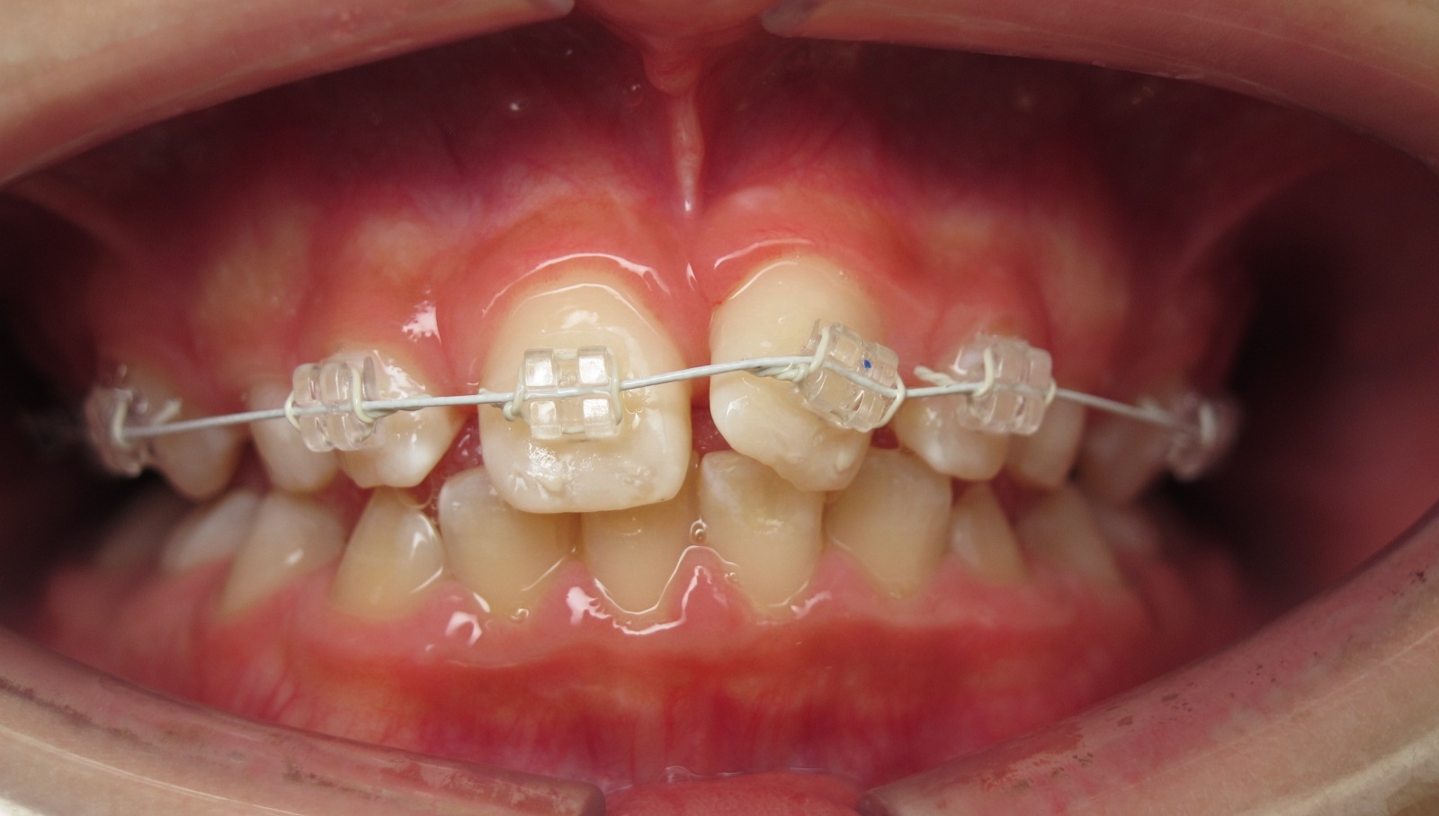 Multibague transparent